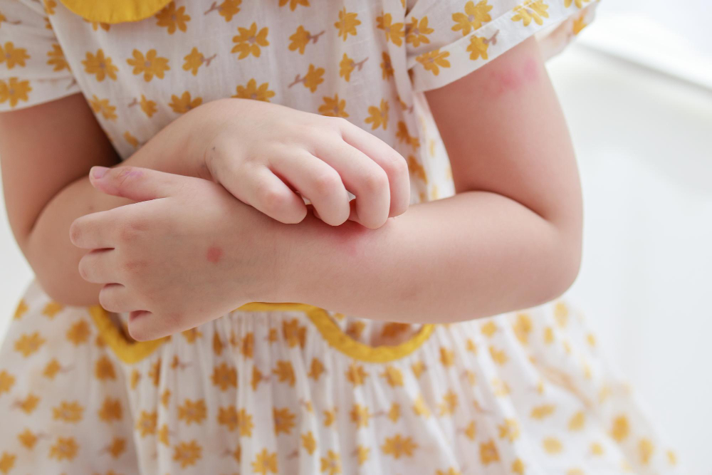 Dermatita seboreică infantilă: Ce trebuie să știi